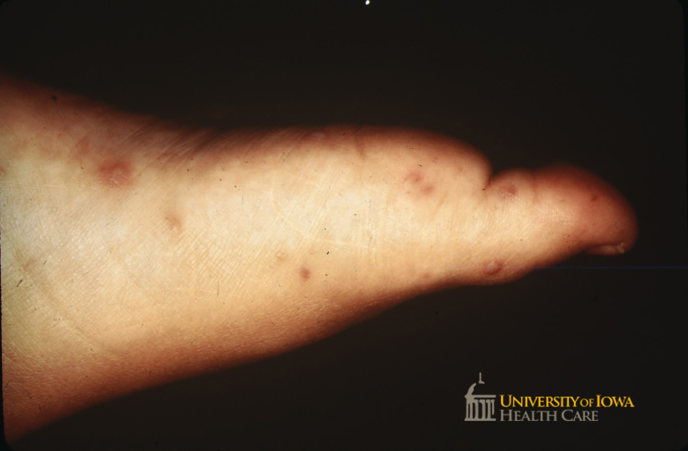 Hyperpigmented papules and vesicles on the foot. (click images for higher resolution).